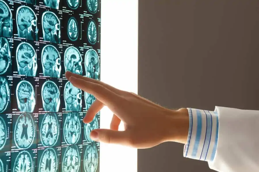 doctor pointing at brain scan