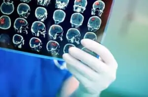 What You Need to Know About Brain Injury Awareness Month